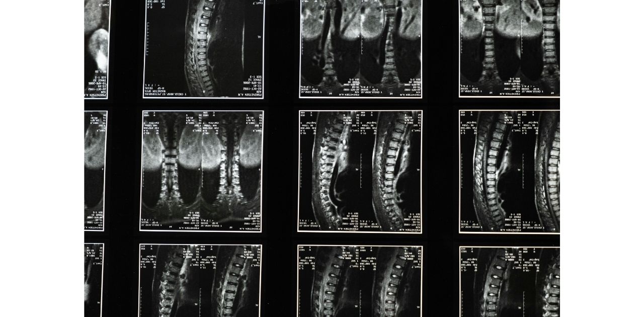 MRI